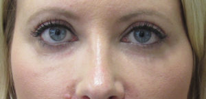 Blepharoplasty (Eyelid Lift Surgery)