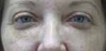 Blepharoplasty (Eyelid Lift Surgery)