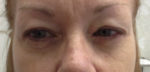 Blepharoplasty (Eyelid Lift Surgery)