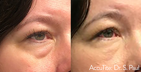 Accutite Before & After by Dr S Paul