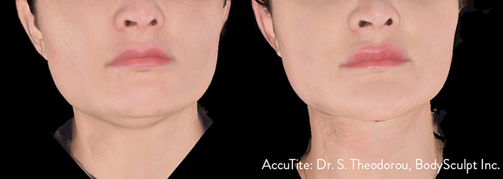 Accutite Before & After by Dr Theodorou