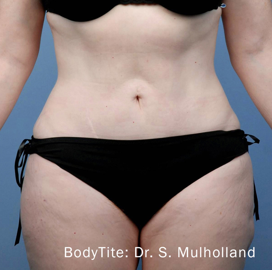 BodyTite Procedure Results Cleveland