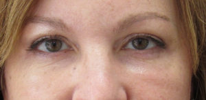 Brow Lifts / Forehead Lifts