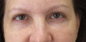 Brow Lifts / Forehead Lifts