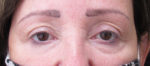 Brow Lifts / Forehead Lifts