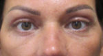 Blepharoplasty (Eyelid Lift Surgery)