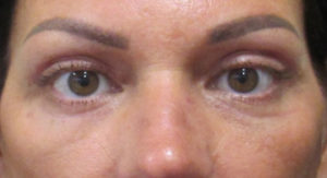 Blepharoplasty (Eyelid Lift Surgery)