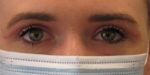 Blepharoplasty (Eyelid Lift Surgery)