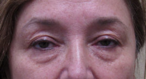 Blepharoplasty (Eyelid Lift Surgery)