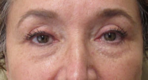 Blepharoplasty (Eyelid Lift Surgery)