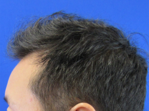 NeoGraft