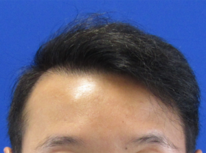 NeoGraft