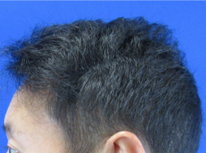 NeoGraft