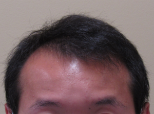 NeoGraft