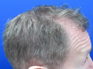 NeoGraft