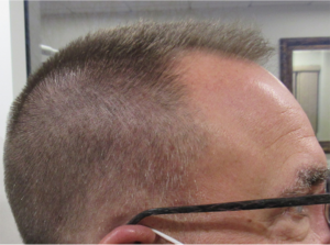 NeoGraft Before & After