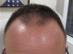 NeoGraft Before & After