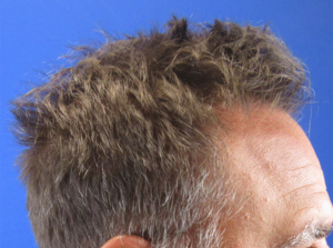 NeoGraft Before & After